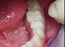 Восстановление зуба металлокерамическим протезом