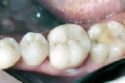 Восстановление зуба керамической коронкой